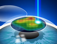 About Bladeless Contoura LASIK