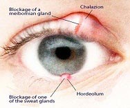 Oculoplasty Treatment
